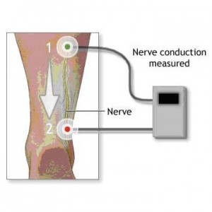 In Office Diagnostic Testing Nerve Conduction Velocity