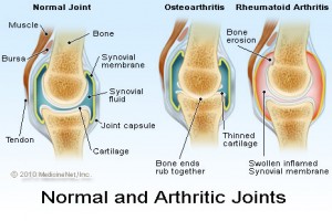 arthritic_joints
