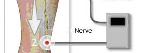 In Office Diagnostic Testing Nerve Conduction Velocity