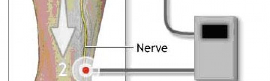 In Office Diagnostic Testing Nerve Conduction Velocity